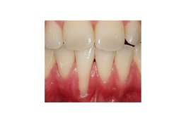 Uitnodiging lezing 18 november: Een recessie is vaak meer dan alleen ‘te weinig gingiva’.